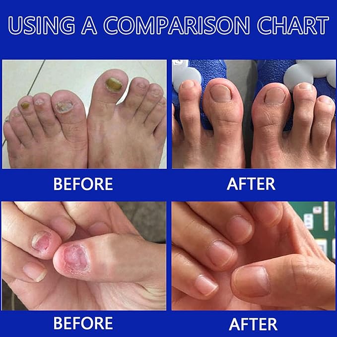 Antihongos Toenailplus